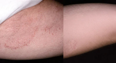 PURE™ Antifungal Soap®