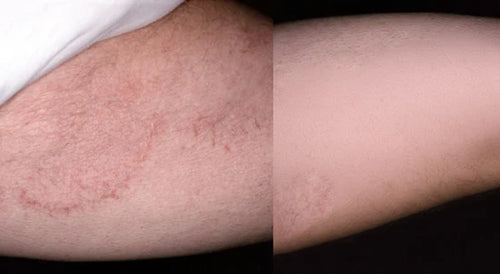 PURE™ Antifungal Soap®